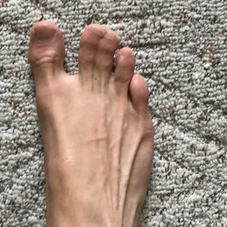 Webbed Toes