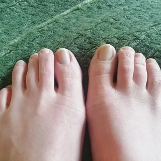 Unsexy Toes